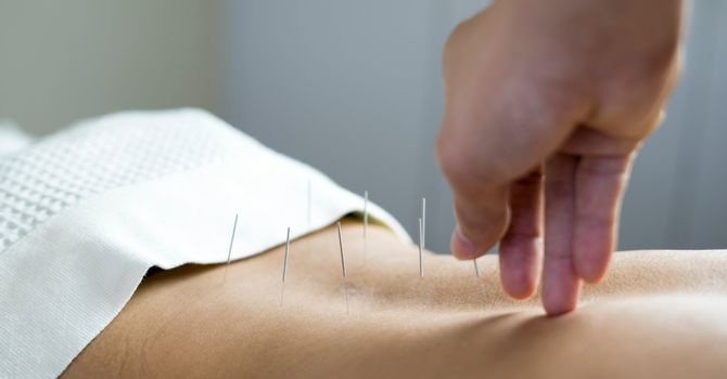 Acupuncture